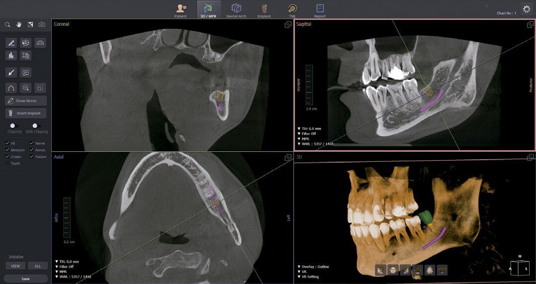 Consulta para Implante