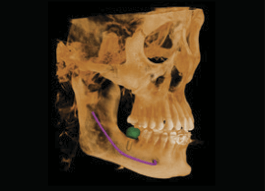 FOV 15x15 (Stitching)