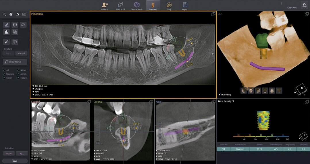 Planejamento cirúrgico de implantes